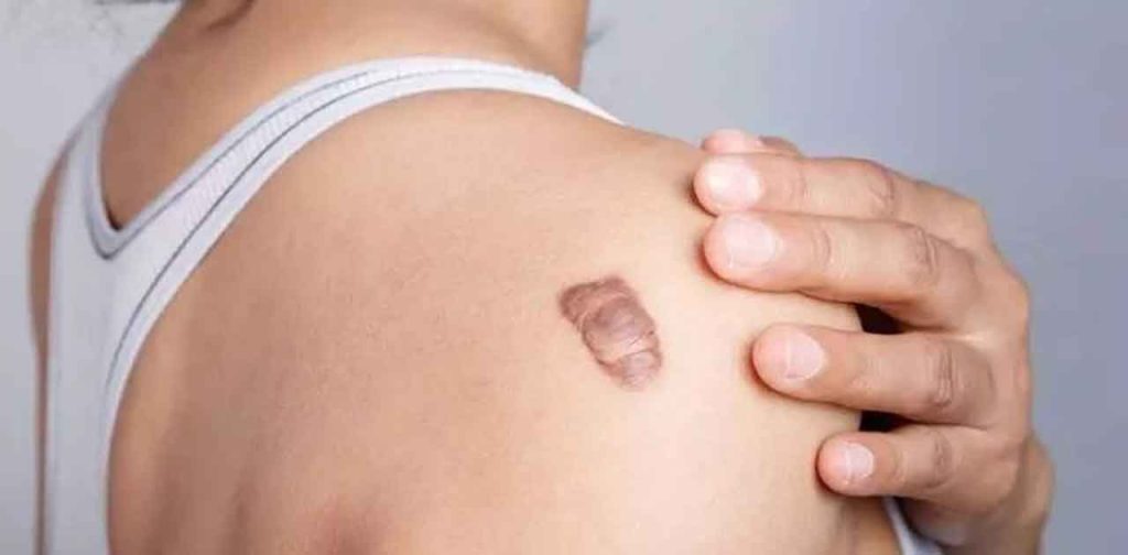 5 dòng máy trị chuyên dụng trị sẹo phì đại