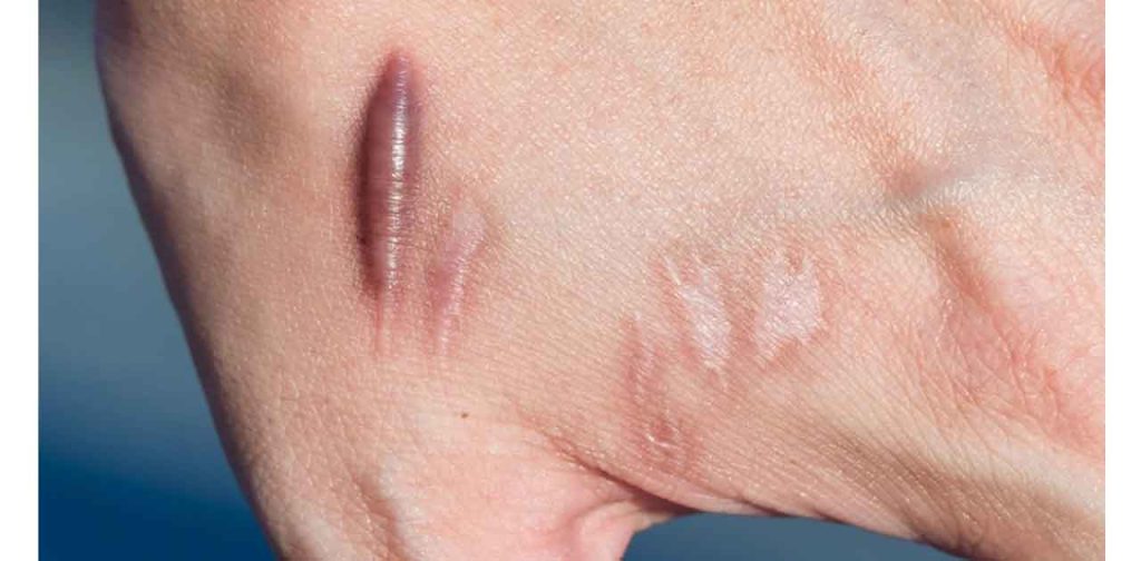 Máy trị sẹo phì đại lâu năm