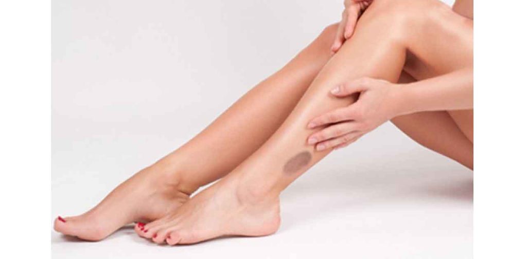 Thiết bị trị sẹo phỏng bô cao cấp