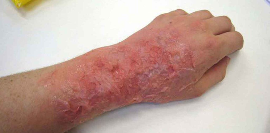 Các loại máy laser trị sẹo bỏng nước sôi