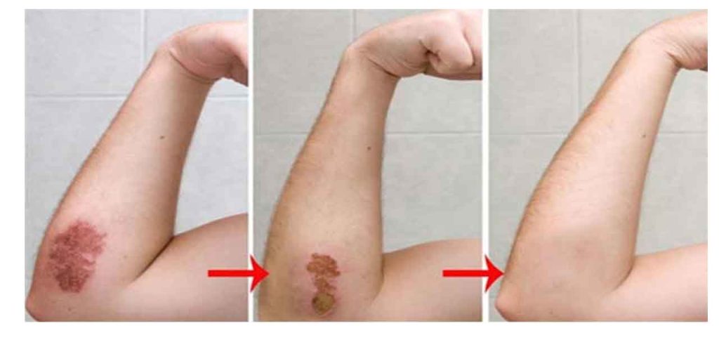 Các dòng máy trị sẹo ướt