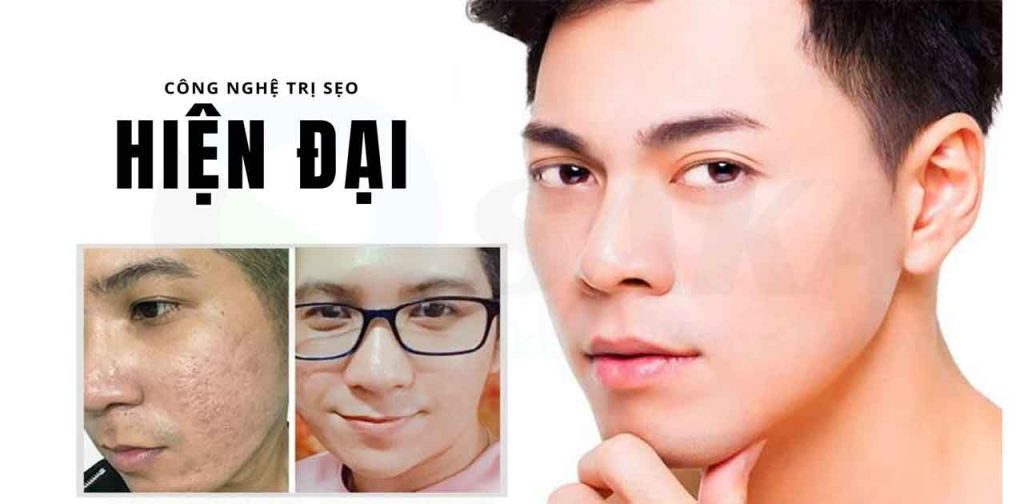 Các loại máy trị sẹo uy tín