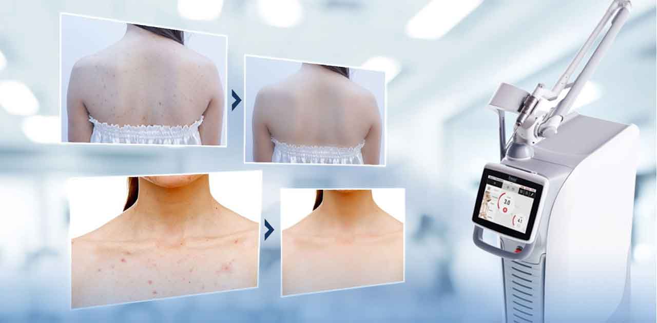 Công nghệ Fusion Plus trị viêm da, tan mỡ hỗ trợ giảm béo