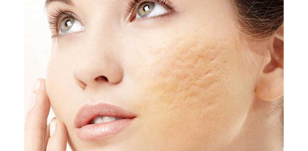 Giá phương pháp là sẹo lõm cơ bản