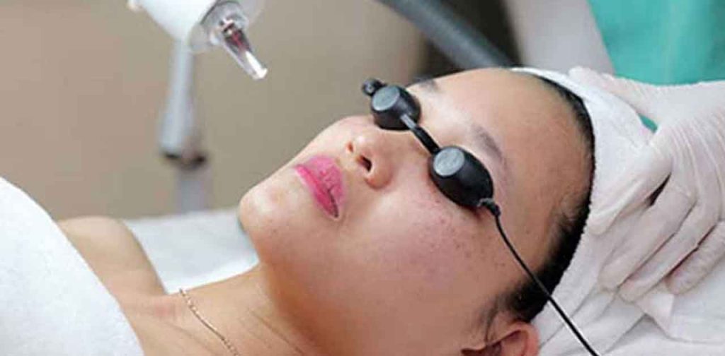 Phương pháp trị tàn nhang bằng laser thẩm mỹ