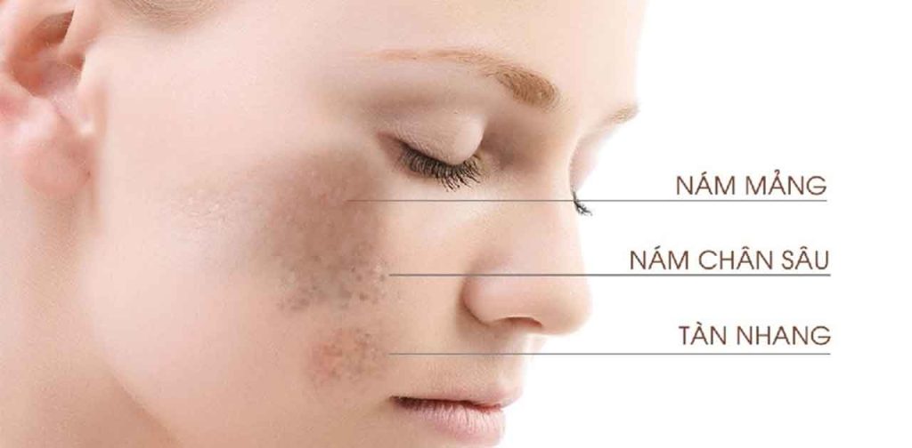 Các giải pháp loại bỏ nám hiệu quả nhất