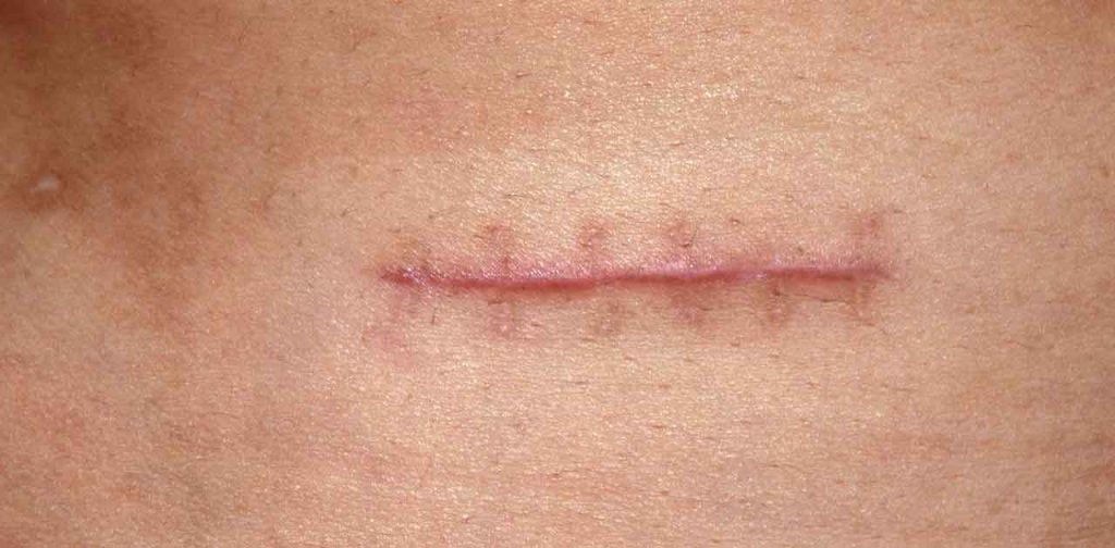 Các dòng máy trị sẹo vết khâu hiệu quả