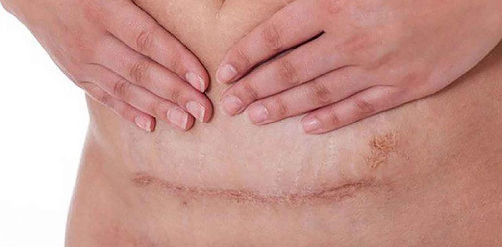 Các dòng thiết bị trị sẹo vết mổ cực uy tín