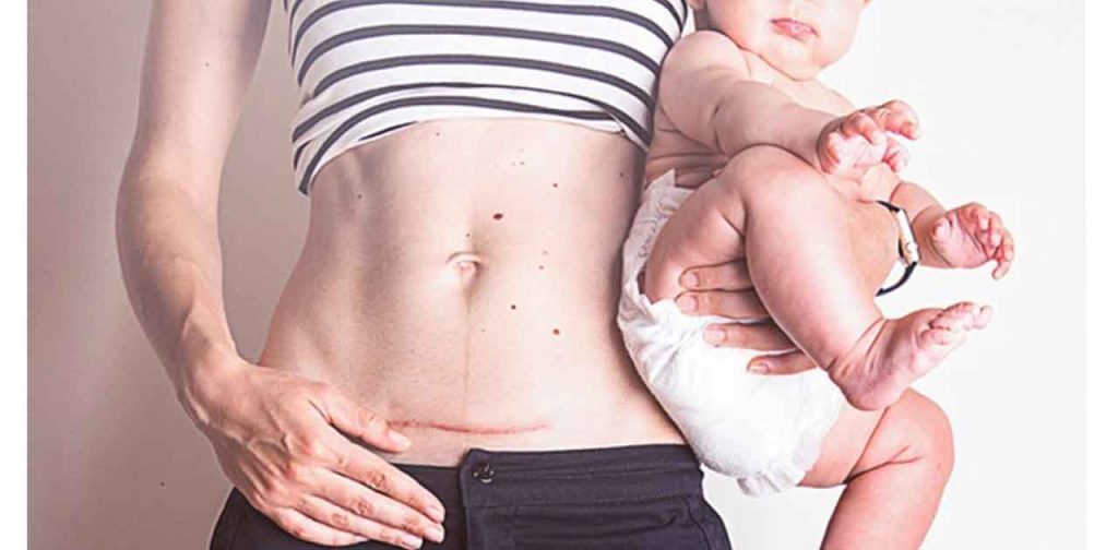 Phương pháp loại bỏ sẹo mổ sau sinh hữu hiệu