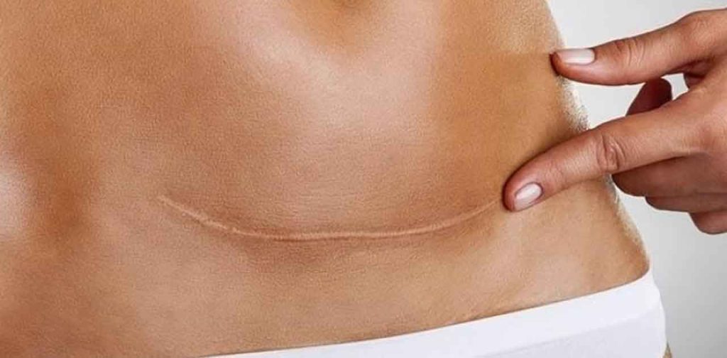 các mẫu trị sẹo vết thương hiệu quả cao