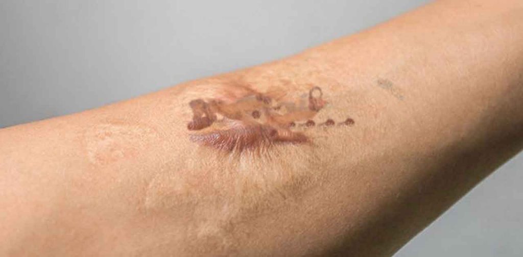 Các phương pháp trị sẹo xơ cứng