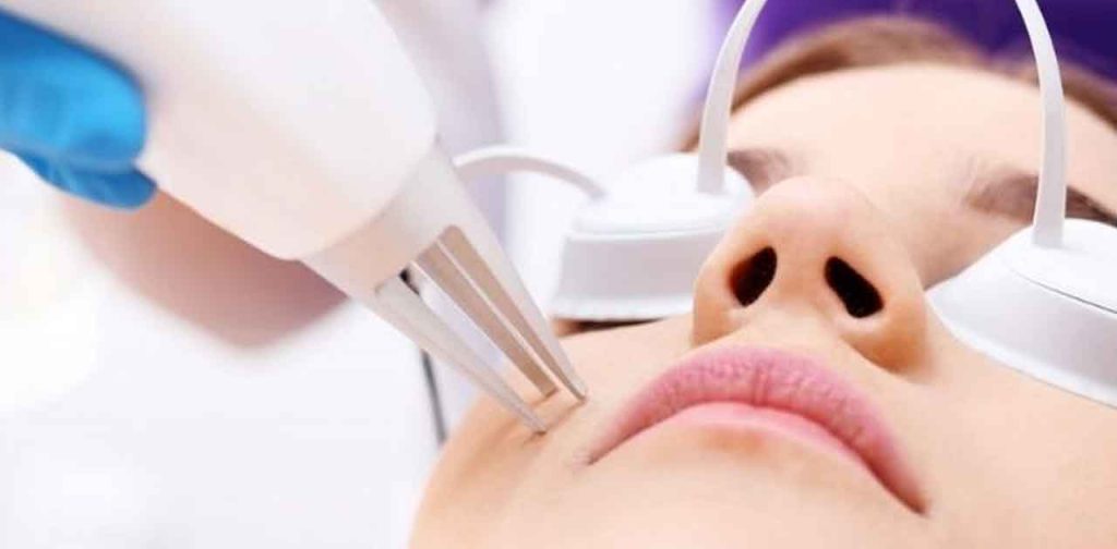 Cận cản quá trình laser trị tàn nhang