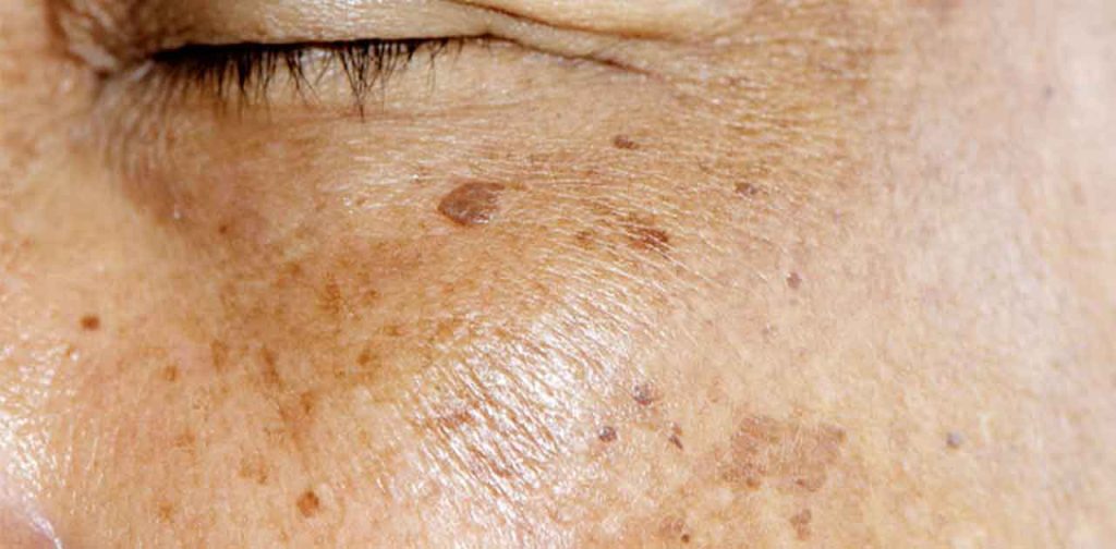 Các phương pháp trị tàn nhang đồi mồi hiệu quả nhất