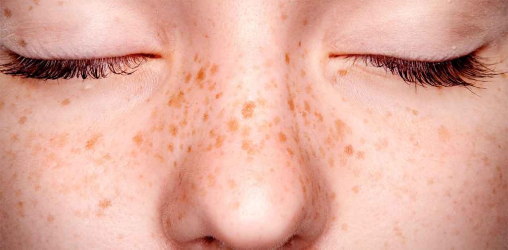 Trị tàn nhanh với các phương pháp hiện đại