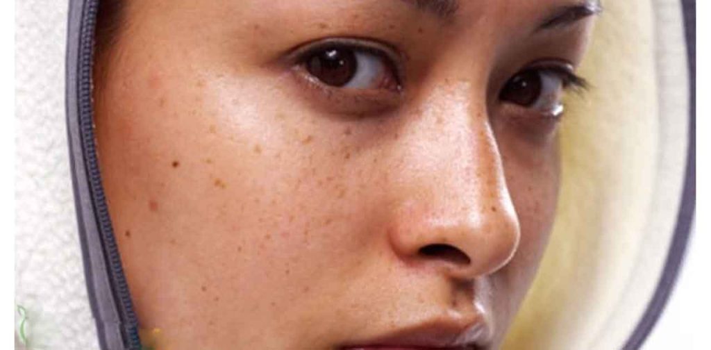 Các phương pháp trị nám trên mặt đơn giản