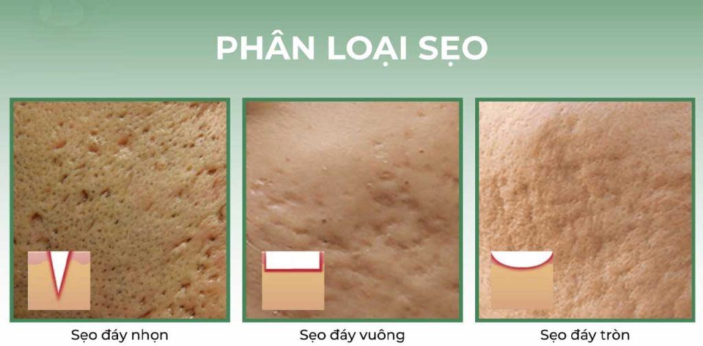 là sẹo hết bao nhiêu tiền