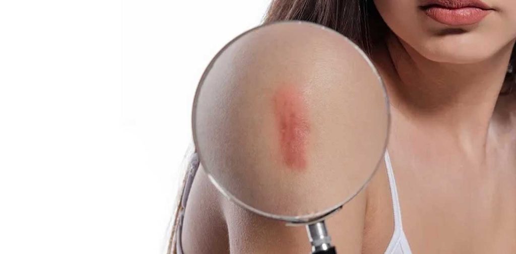 Cách trị sẹo lồi an toàn với laser