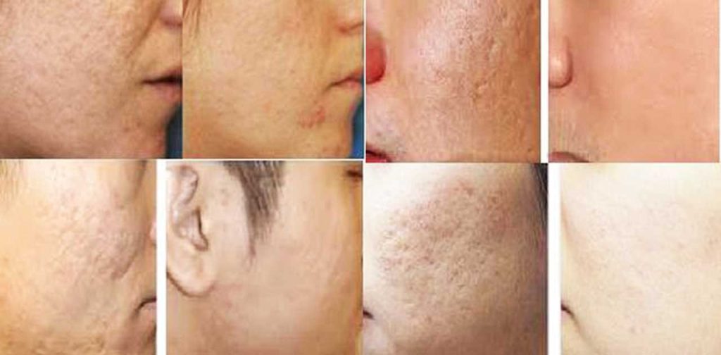 Phương pháp trị sẹo an toàn bằng laser